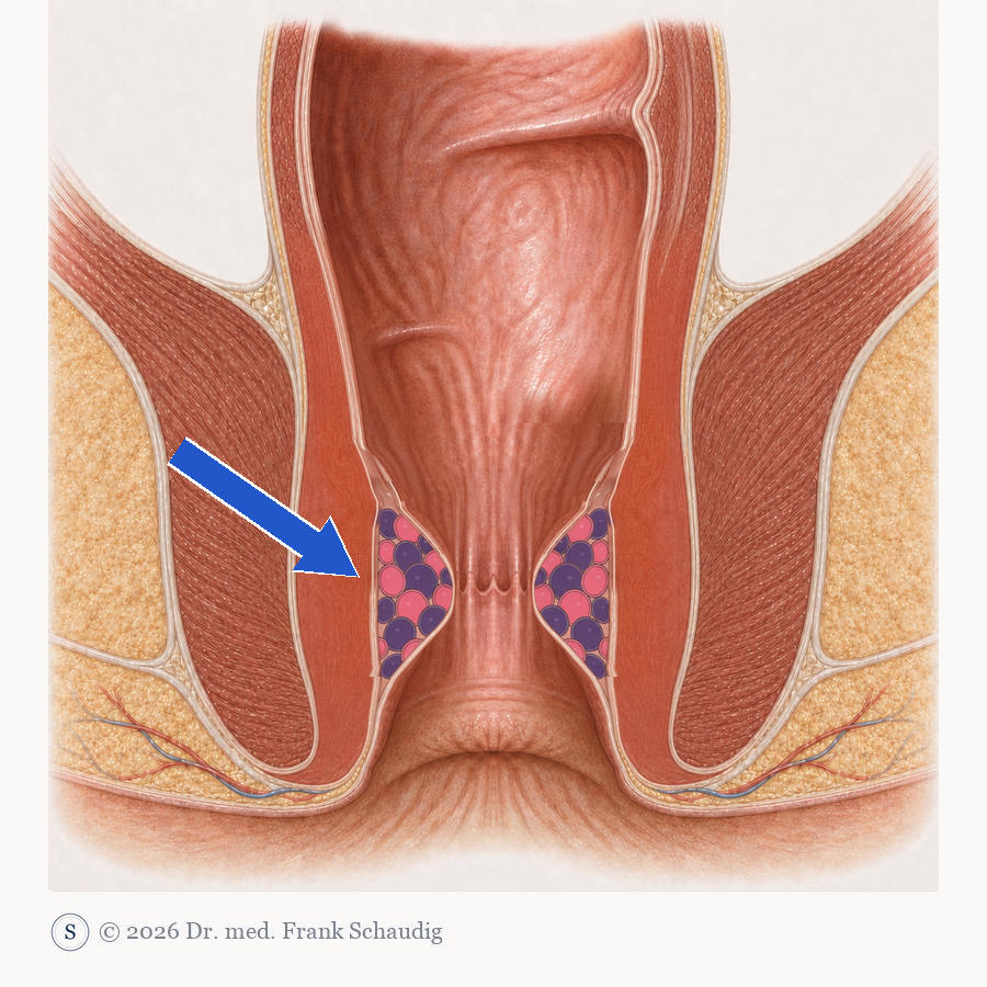 Hämorrhoiden – schematische Zeichnung