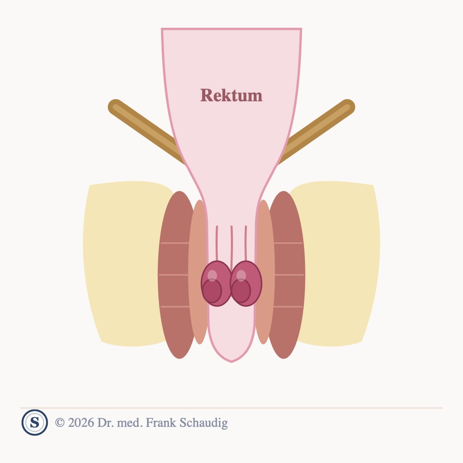 Hämorrhoiden – schematische Zeichnung
