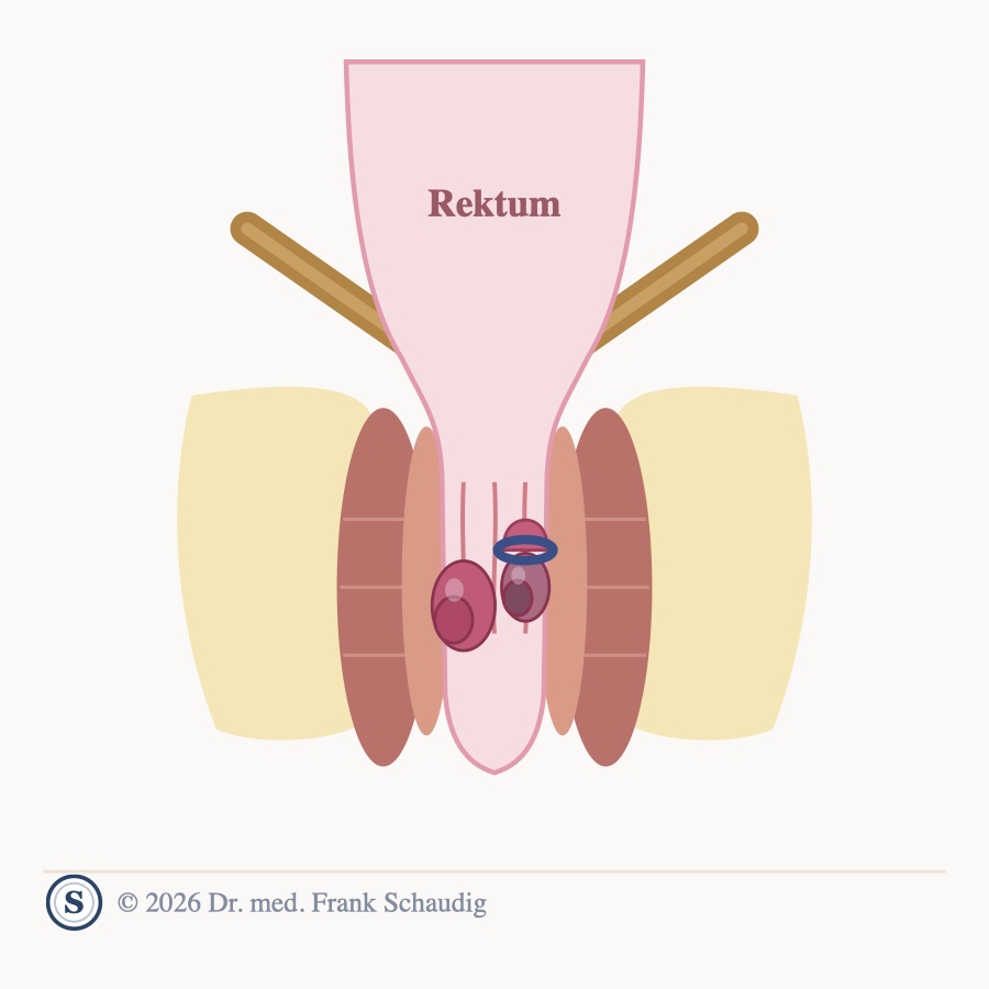 H&auml;morrhoidenbehandlung &ndash; schematische Zeichnung