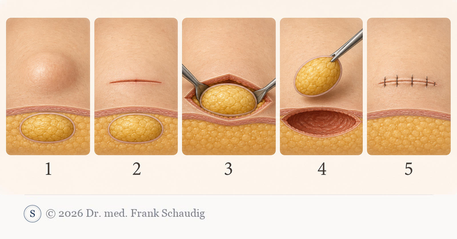 Entfernung eines Lipoms in fünf Schritten