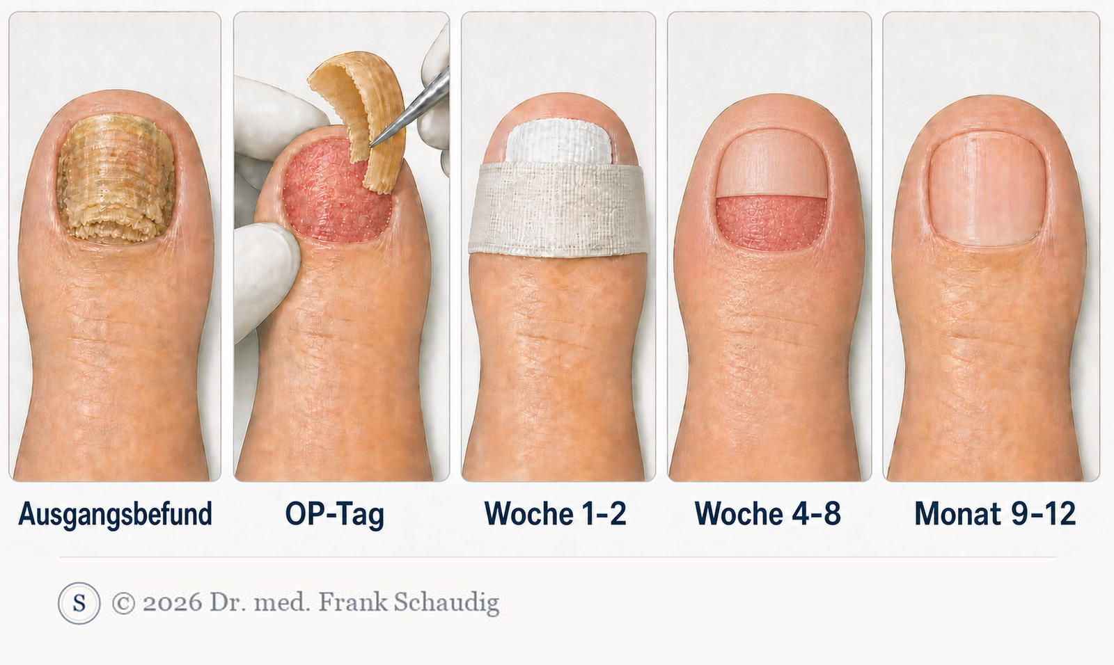 Nagelentfernung und Heilungsverlauf in fünf Abschnitten