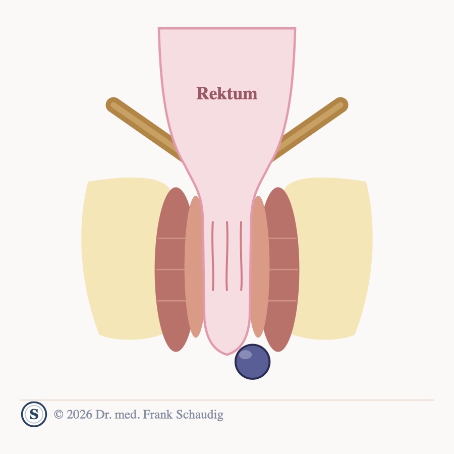 Analvenenthrombose &ndash; schematische Zeichnung