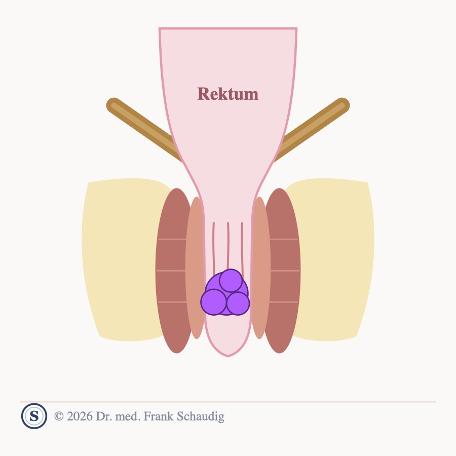 Analkarzinom &ndash; schematische Zeichnung