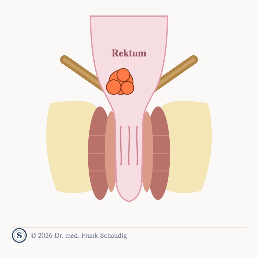 Rektumkarzinom &ndash; schematische Zeichnung