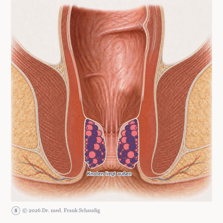 Hämorrhoiden, Grad III – muss zurückgeschoben werden