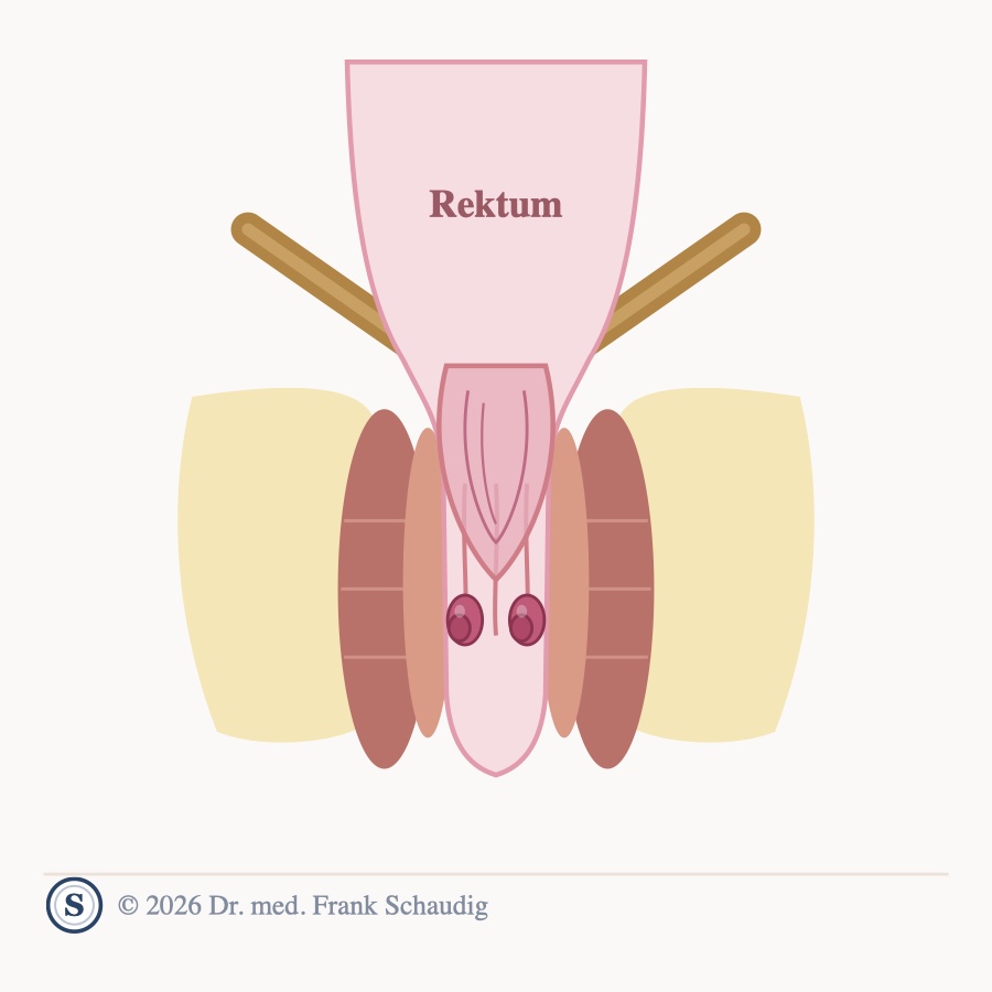 Mukosaprolaps-Syndrom &ndash; schematische Zeichnung
