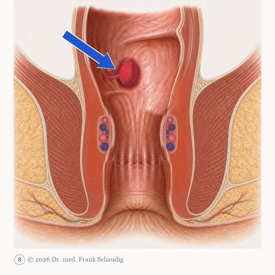 Polyp / Adenom &ndash; schematische Zeichnung