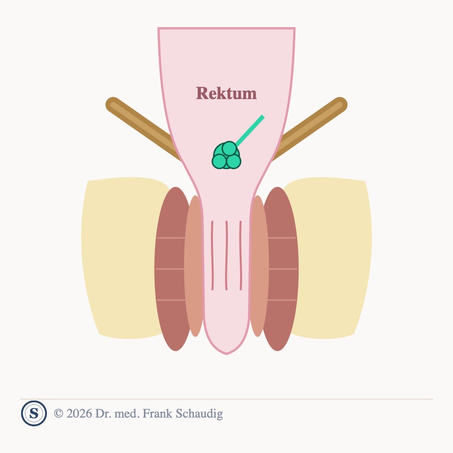 Polyp / Adenom &ndash; schematische Zeichnung